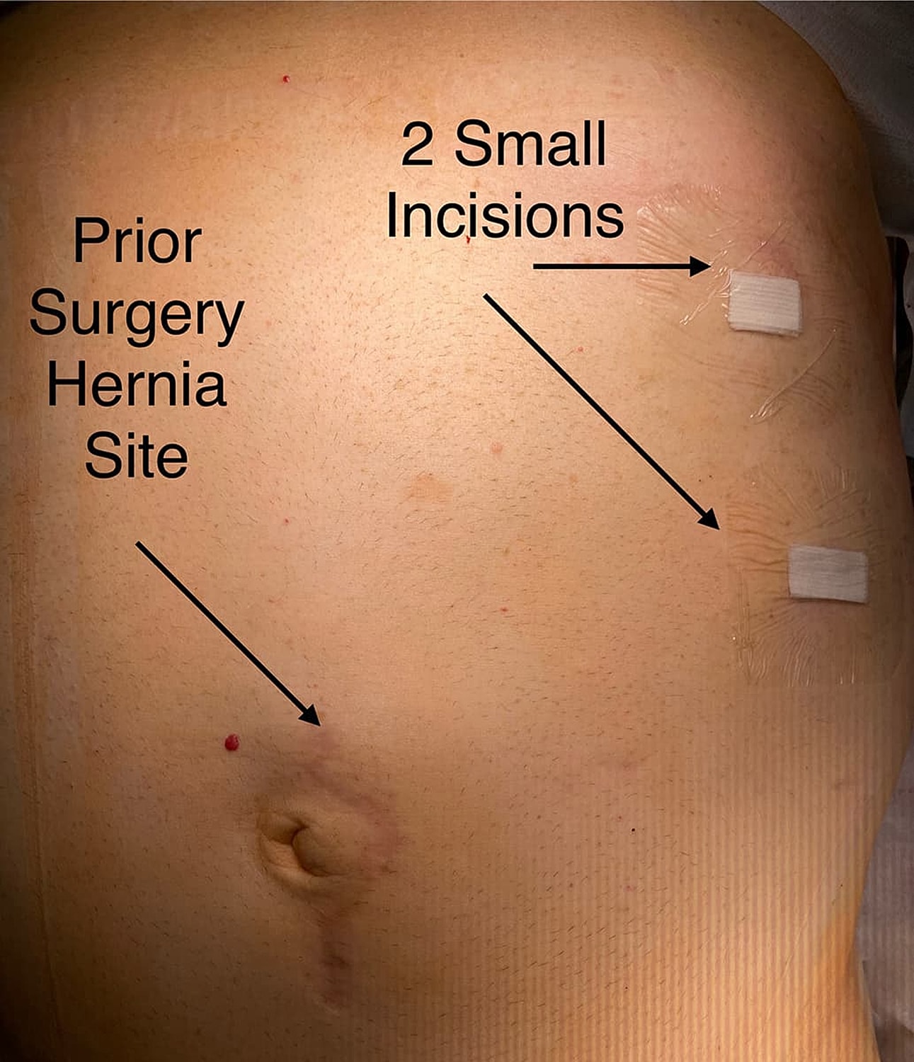Prior hernia surgery site with small incisions.