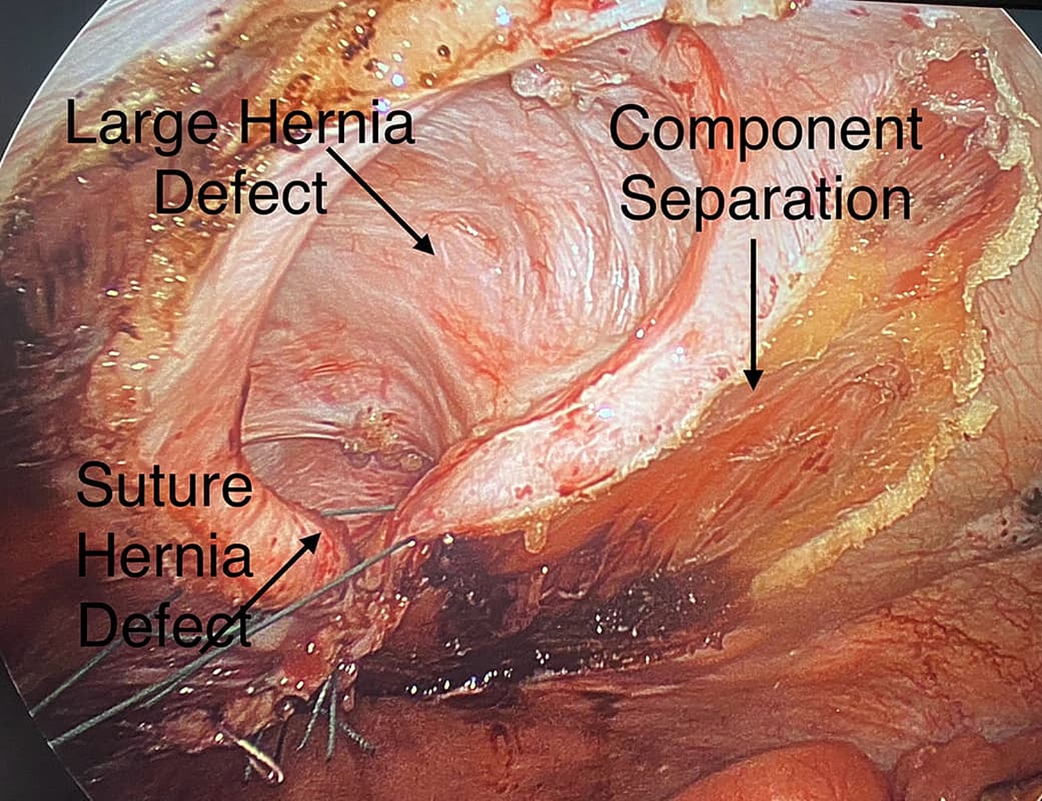 Intraoperative view of hernia defects and separation.