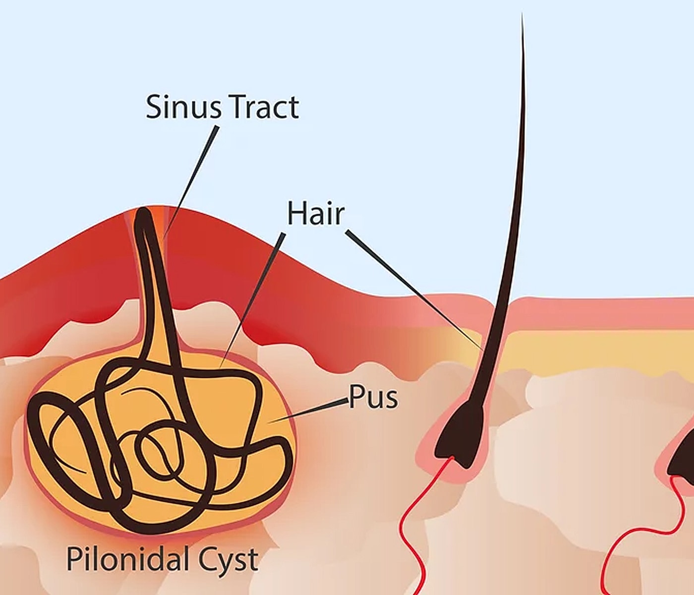 Pilonidal cyst anatomy with sinus tract labeled.