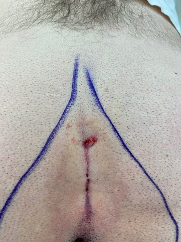 Pilonidal Cyst Treatment Gallery Advanced Minimally Invasive Surgery in Newton Before & After