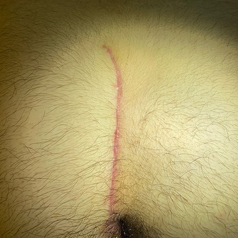 Pilonidal Cyst Treatment Gallery Advanced Minimally Invasive Surgery in Newton Before & After